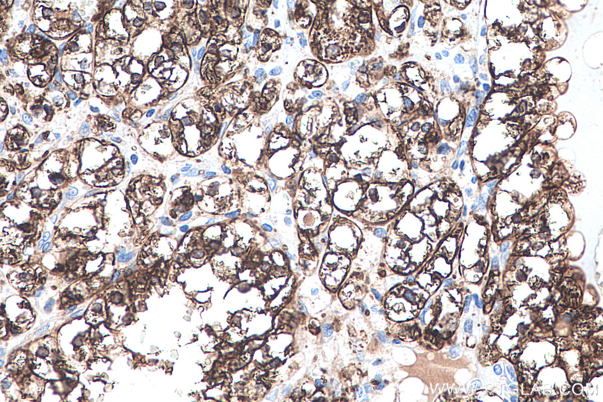 IHC staining of human renal cell carcinoma using 60340-1-Ig