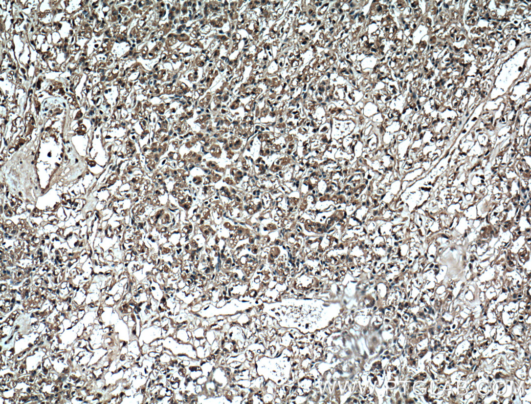 IHC staining of human renal cell carcinoma using 60340-1-Ig