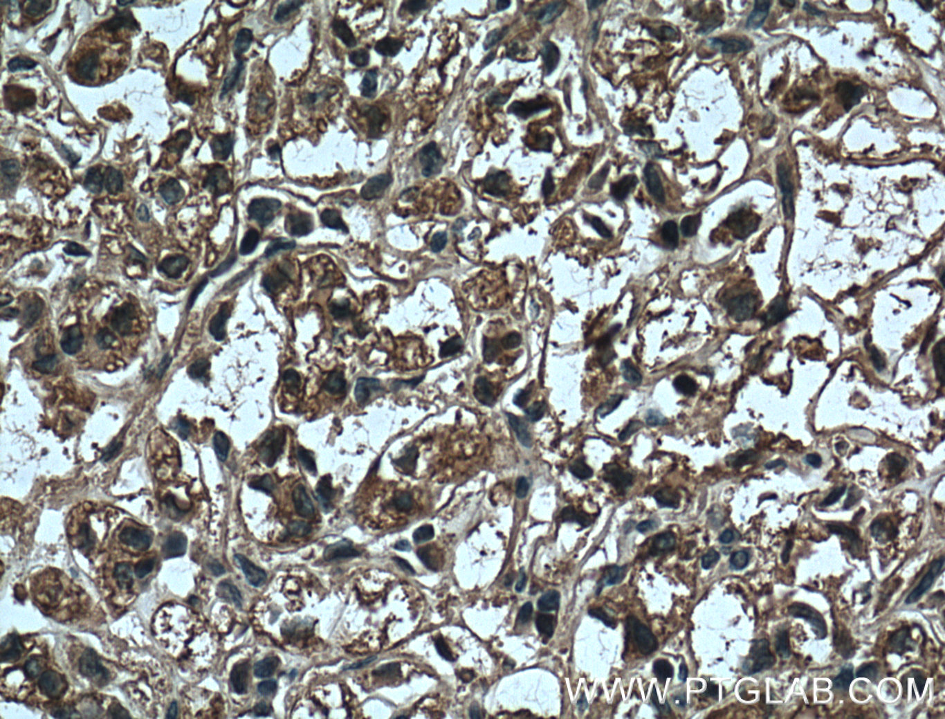 IHC staining of human renal cell carcinoma using 60340-1-Ig