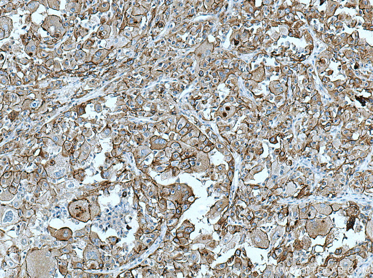 IHC staining of human liver cancer using 26332-1-AP