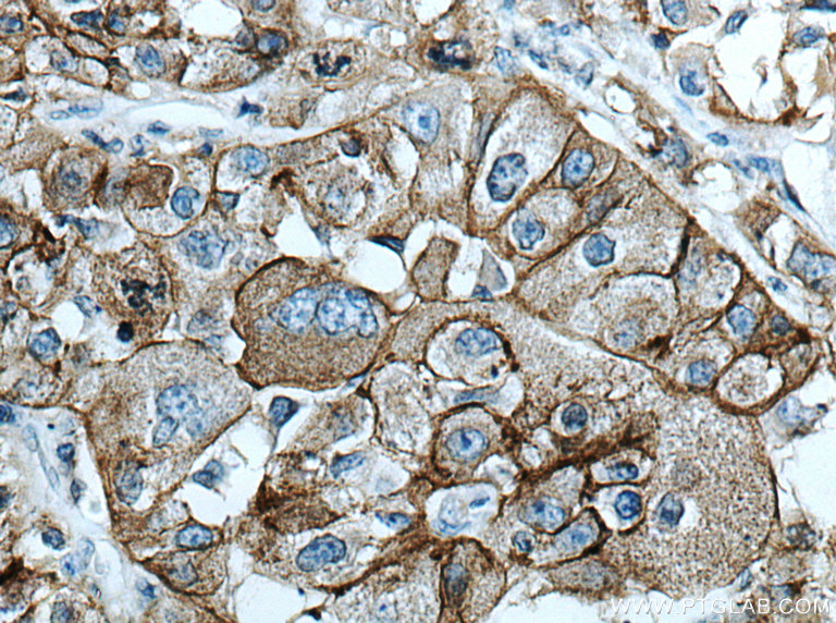 IHC staining of human liver cancer using 26332-1-AP