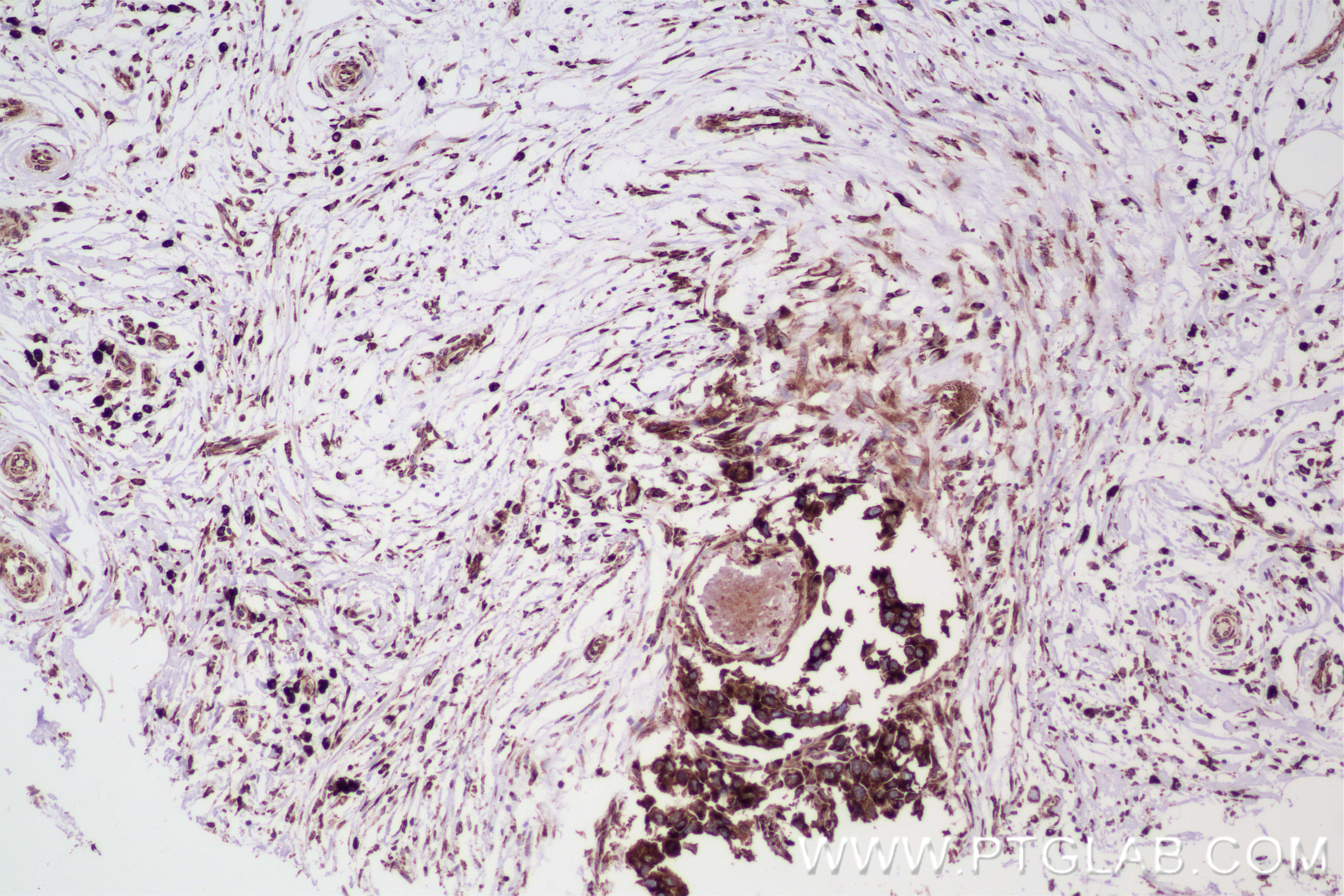 IHC staining of human breast cancer using 84686-4-RR IHC staining of human breast cancer using 84686-4-RR