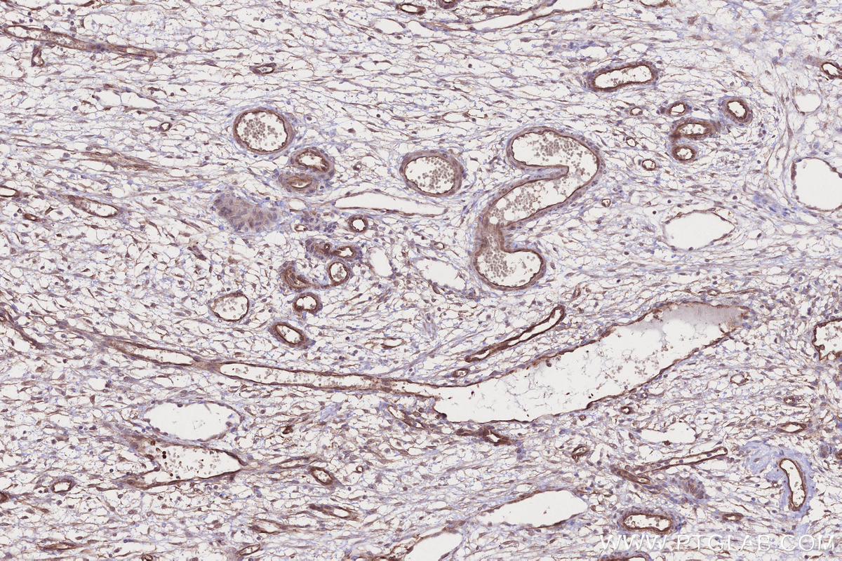 IHC staining of human ovary cancer using 17183-1-AP IHC staining of human ovary cancer using 17183-1-AP