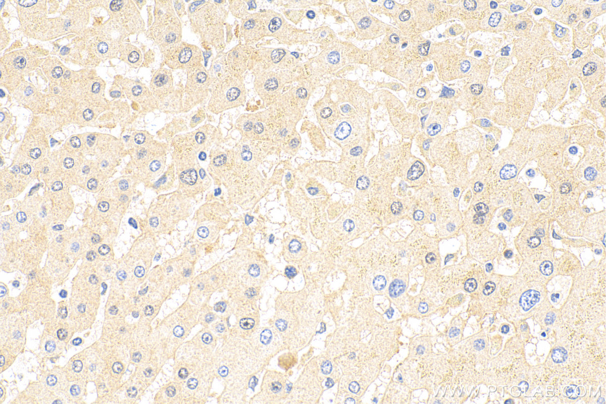 IHC staining of human hepatocirrhosis using 32214-1-AP