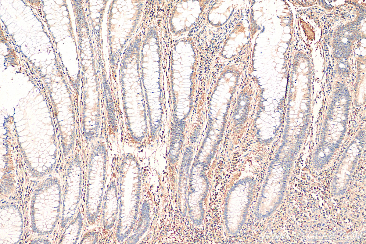 IHC staining of human colon cancer using 81083-1-RR (same clone as 81083-1-PBS)