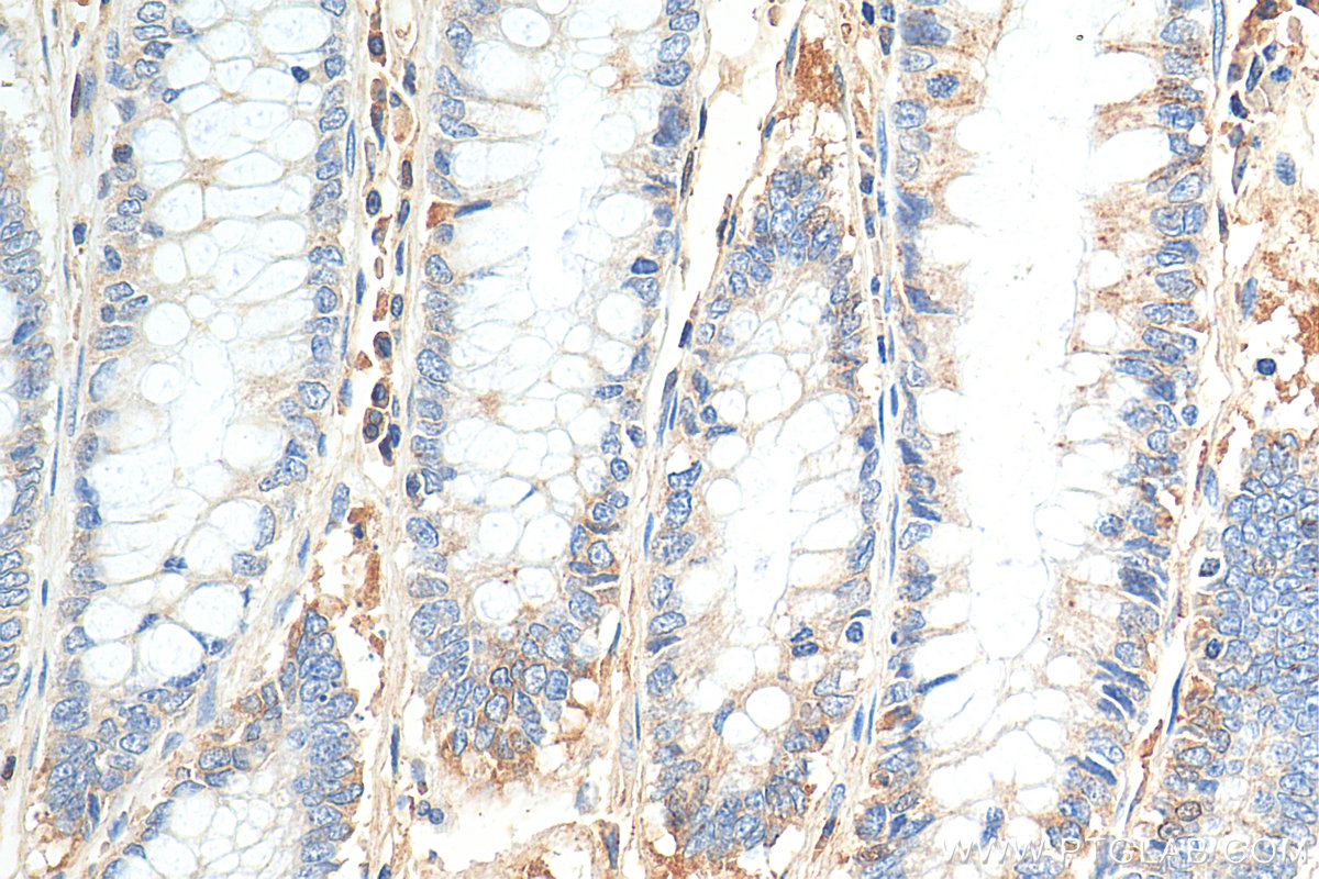 IHC staining of human colon cancer using 81083-1-RR (same clone as 81083-1-PBS)