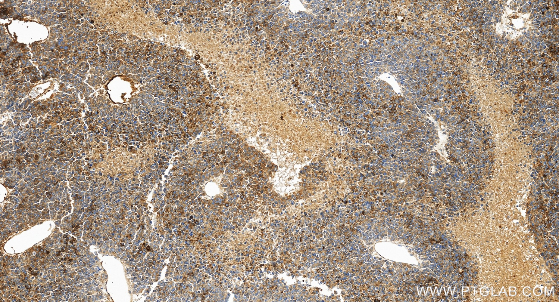 IHC staining of human liver cancer using 82982-6-RR