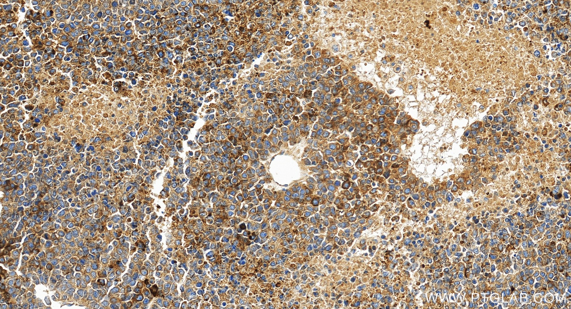 IHC staining of human liver cancer using 82982-6-RR