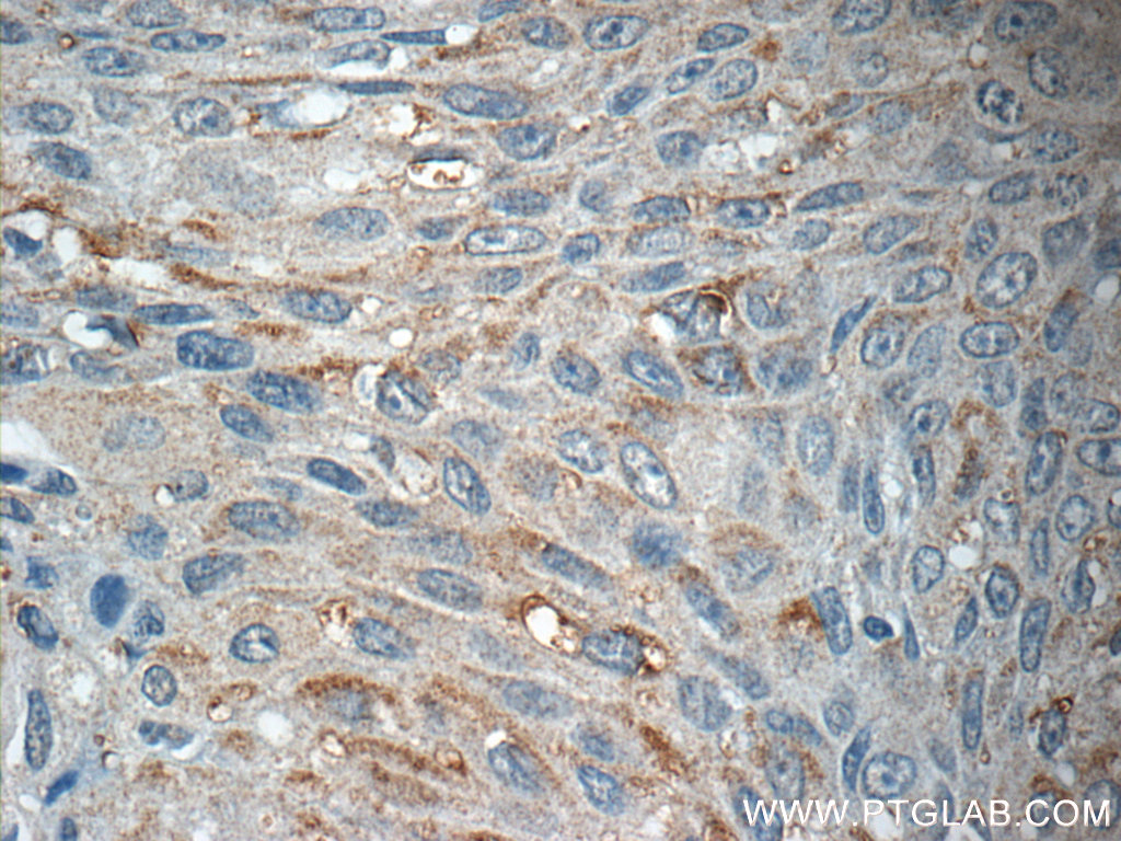 IHC staining of human lung cancer using 16990-1-AP