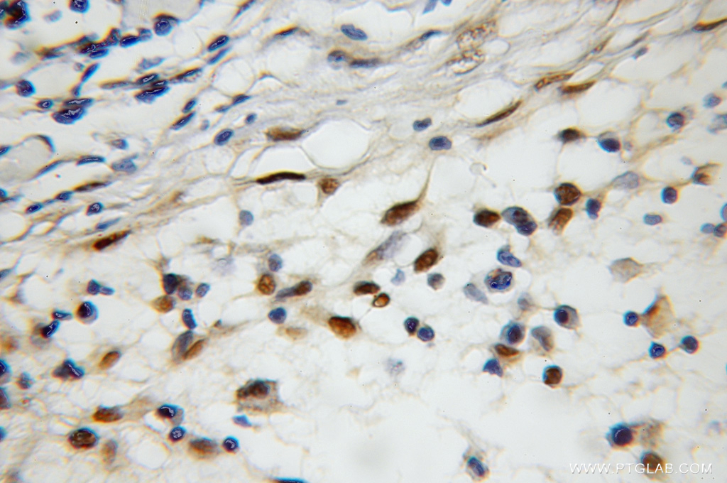 IHC staining of human lymphoma using 11919-1-AP