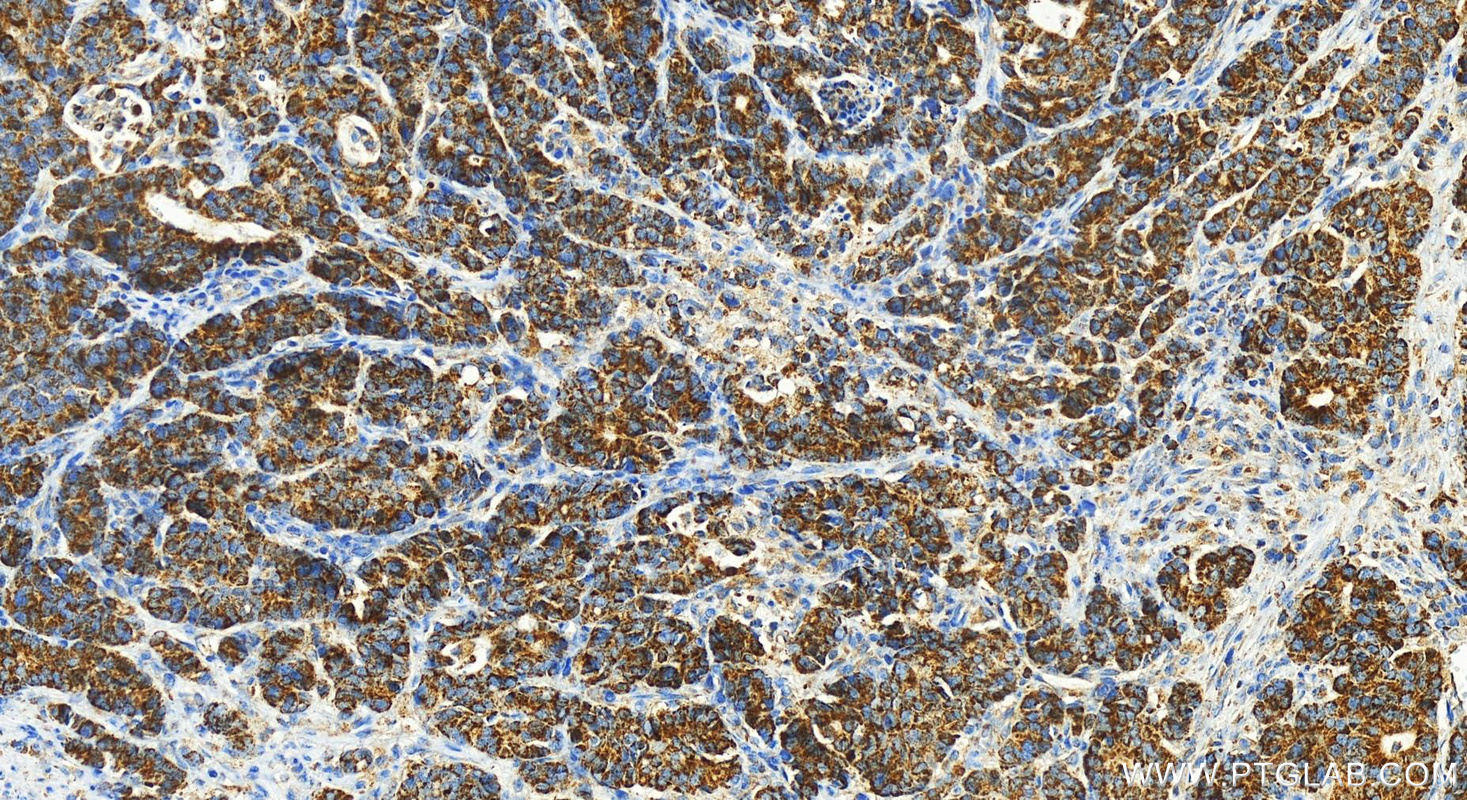 IHC staining of human stomach cancer using 21899-1-AP