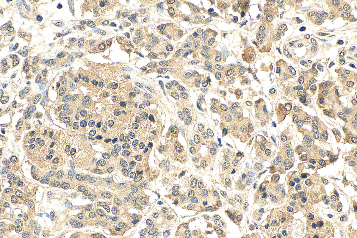 IHC staining of human pancreas cancer using 67934-1-Ig