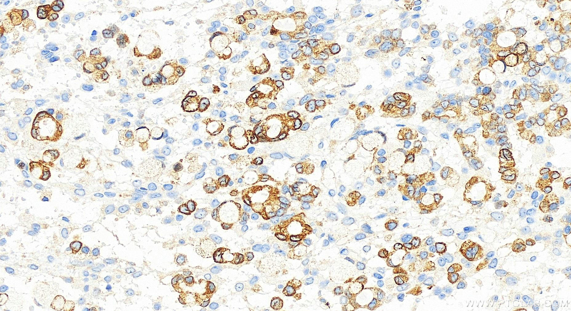 IHC staining of human ovary cancer using 83349-3-RR (same clone as 83349-3-PBS)