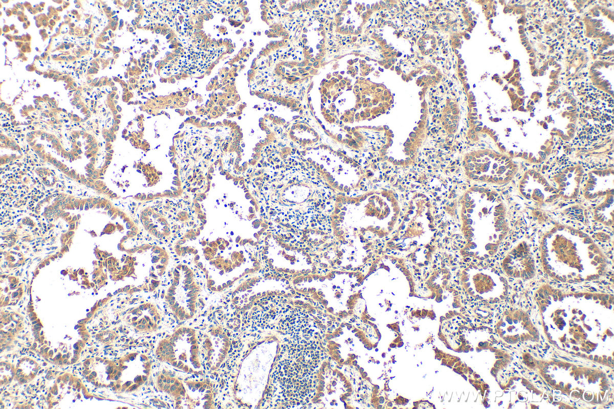 IHC staining of human lung cancer using 16562-1-AP
