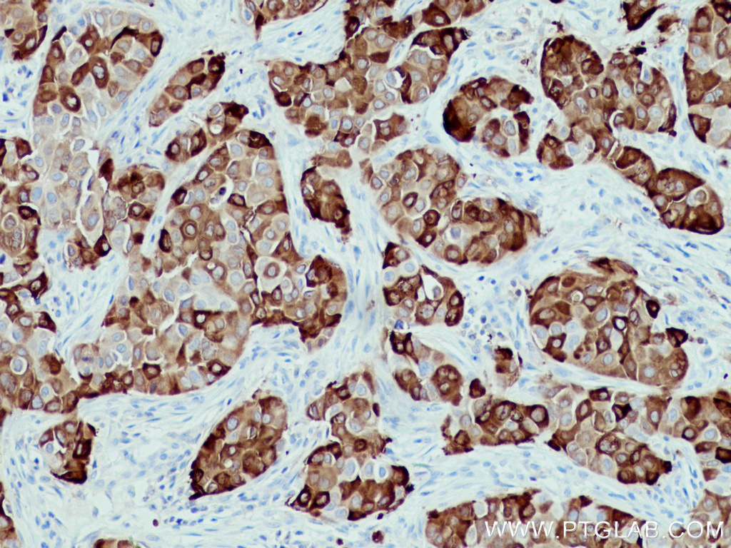 IHC staining of human breast cancer using 66768-1-Ig