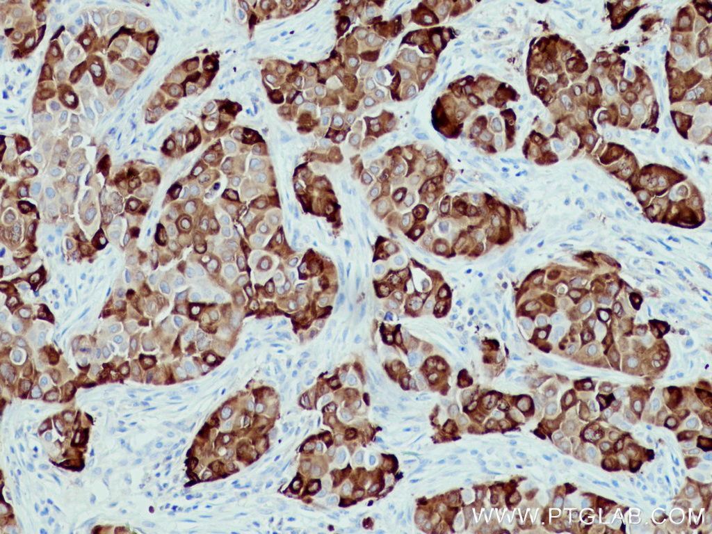 IHC staining of human breast cancer using 66768-1-Ig (same clone as 66768-1-PBS)