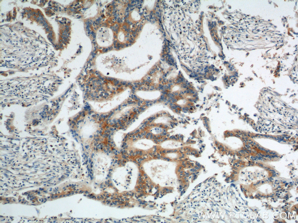 IHC staining of human pancreas cancer using 11559-1-AP