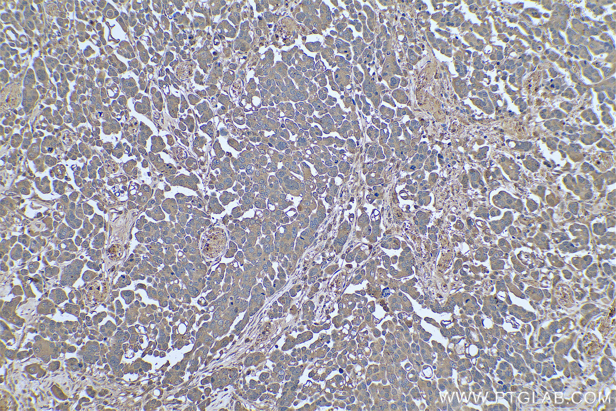 IHC staining of human colon cancer using 66019-1-Ig