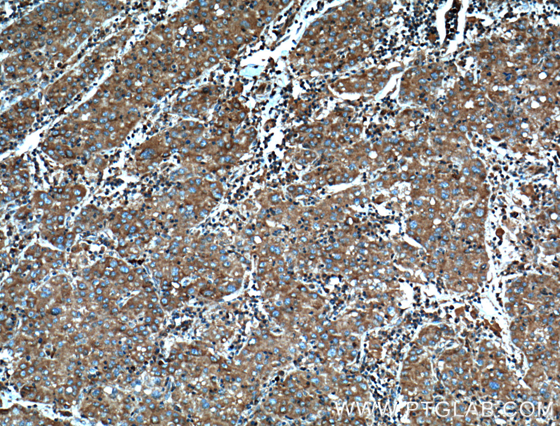IHC staining of human liver cancer using 10658-3-AP