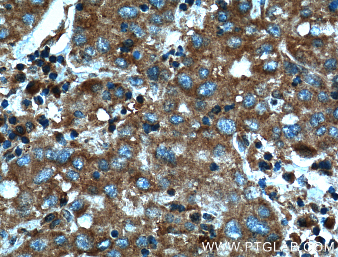 IHC staining of human liver cancer using 10658-3-AP