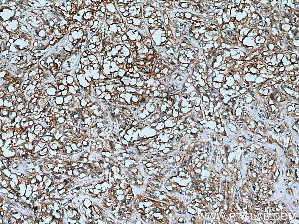 IHC staining of human renal cell carcinoma using 17682-1-AP