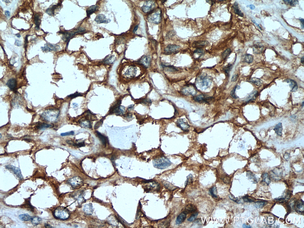 IHC staining of human renal cell carcinoma using 17682-1-AP