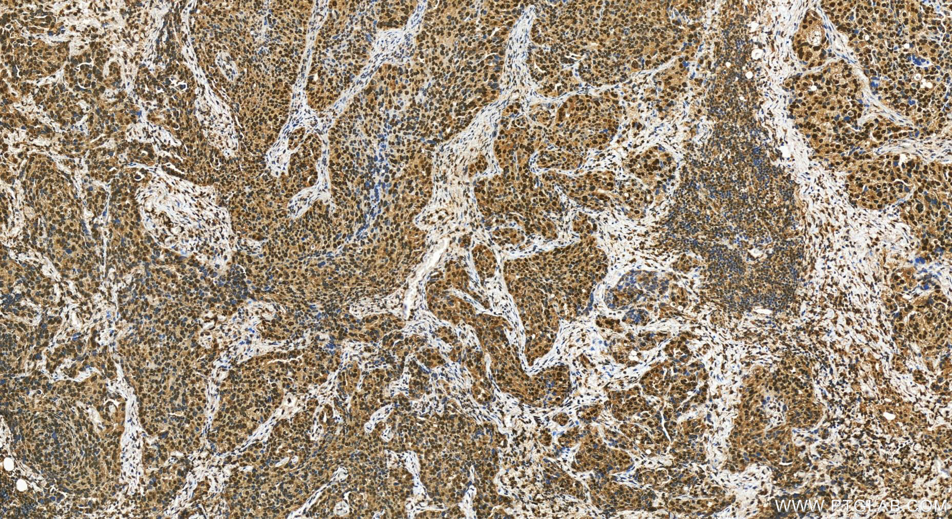IHC staining of human ovary cancer using 30242-1-AP