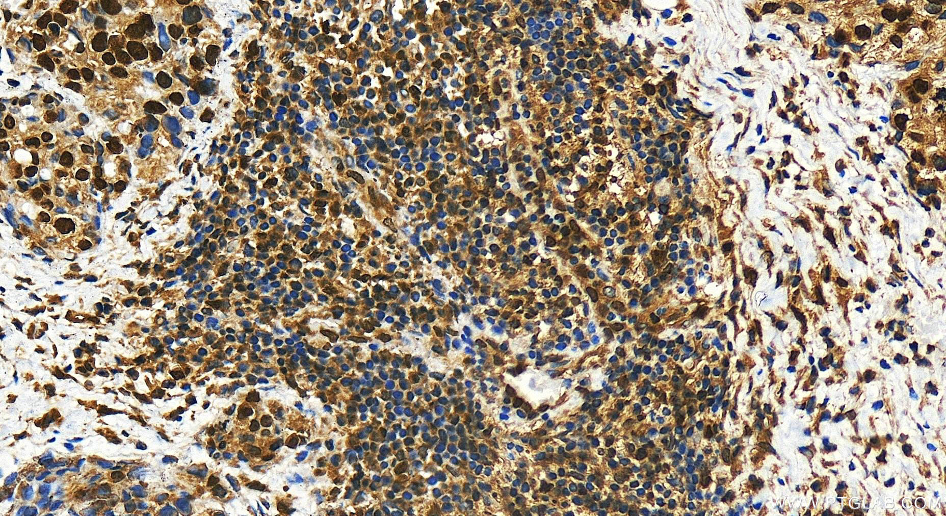 IHC staining of human ovary cancer using 30242-1-AP