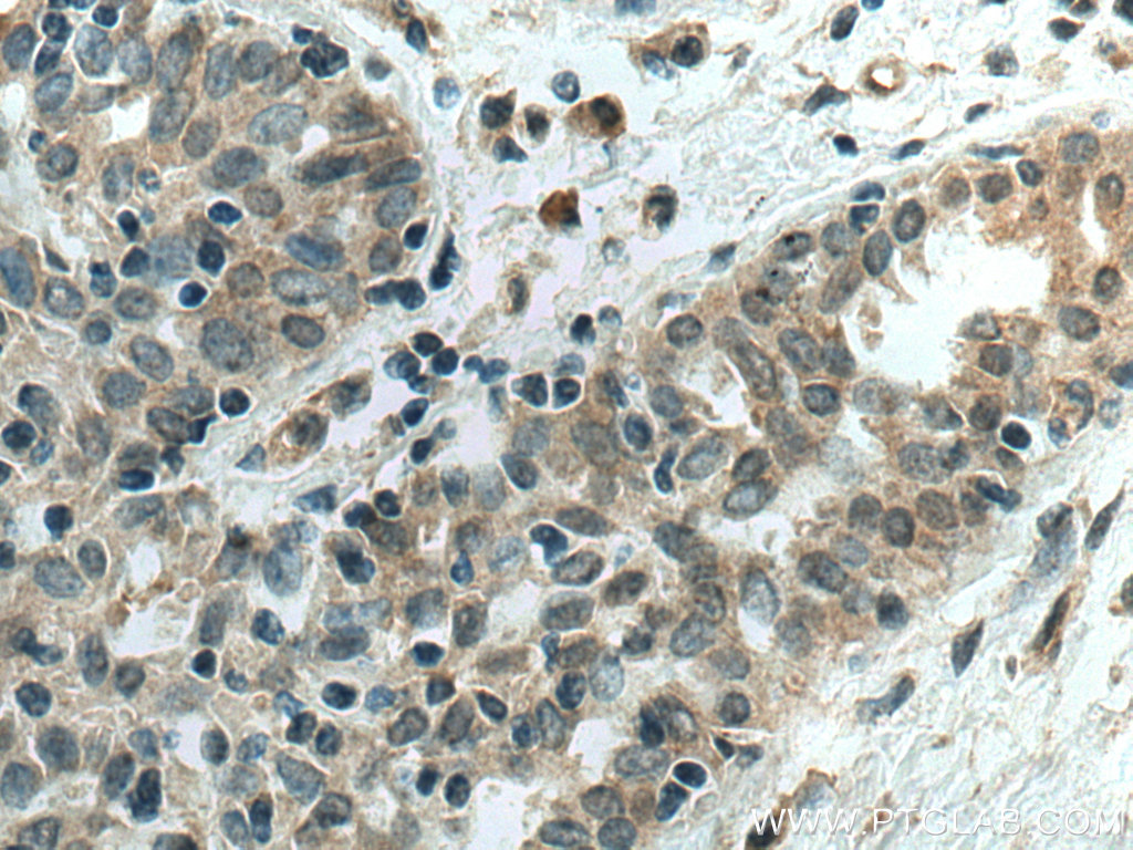 IHC staining of human breast cancer using 67785-1-Ig