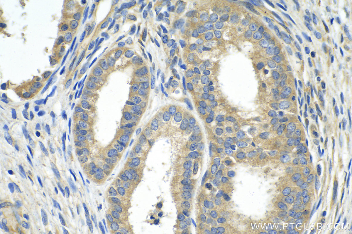 IHC staining of human ovary tumor using 14778-1-AP