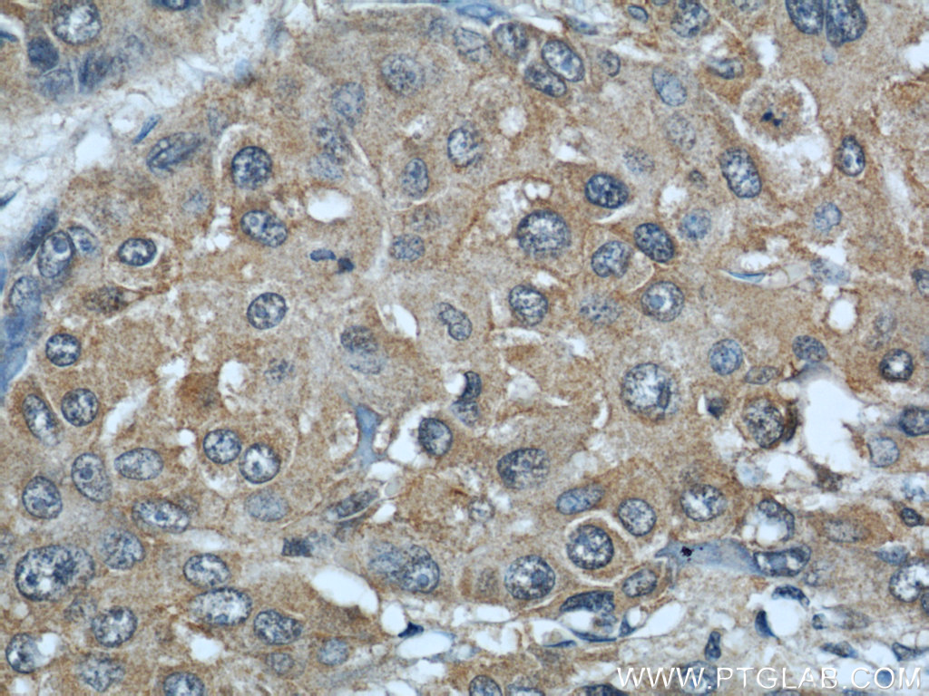 IHC staining of human liver cancer using 18176-1-AP