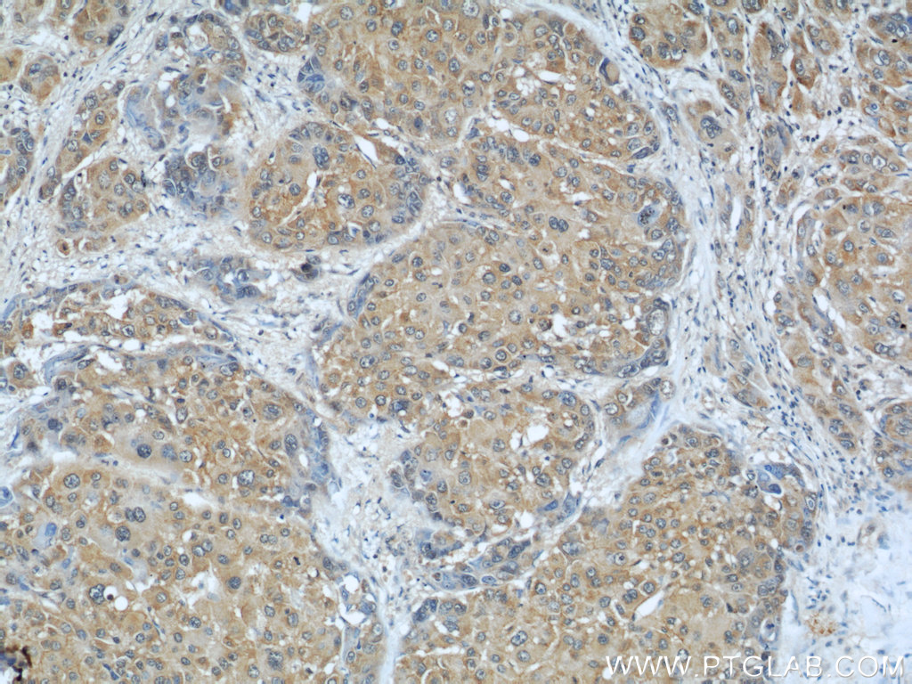 IHC staining of human liver cancer using 18176-1-AP