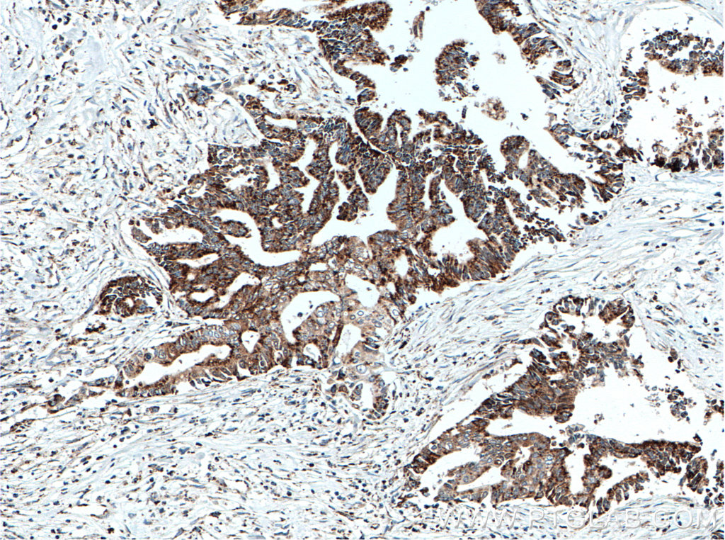 IHC staining of human pancreas cancer using 11014-1-AP