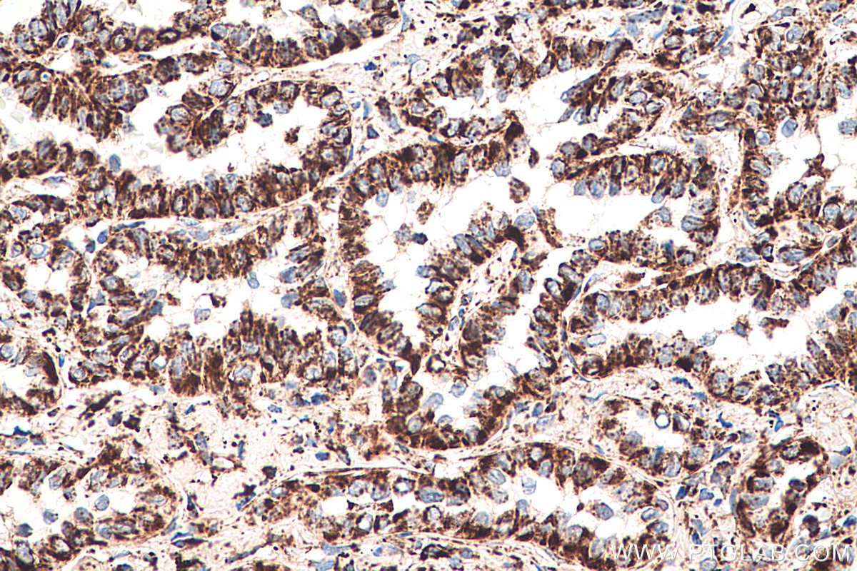 IHC staining of human lung cancer using 66127-1-Ig (same clone as 66127-1-PBS)