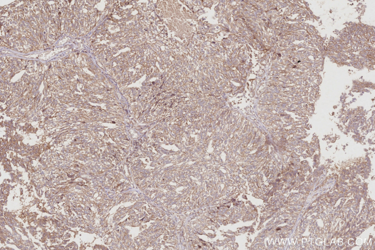 IHC staining of human ovary cancer using 30552-1-AP IHC staining of human ovary cancer using 30552-1-AP