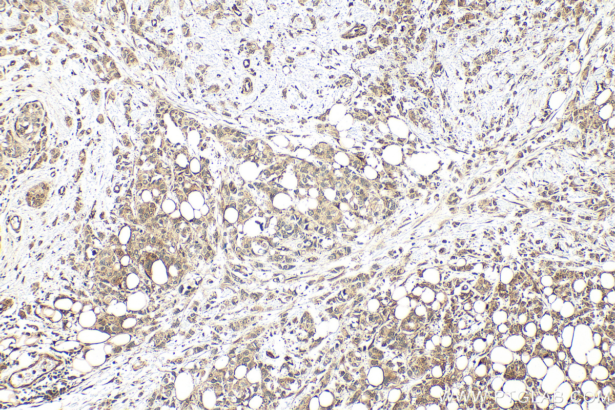 IHC staining of human breast cancer using RMX00069