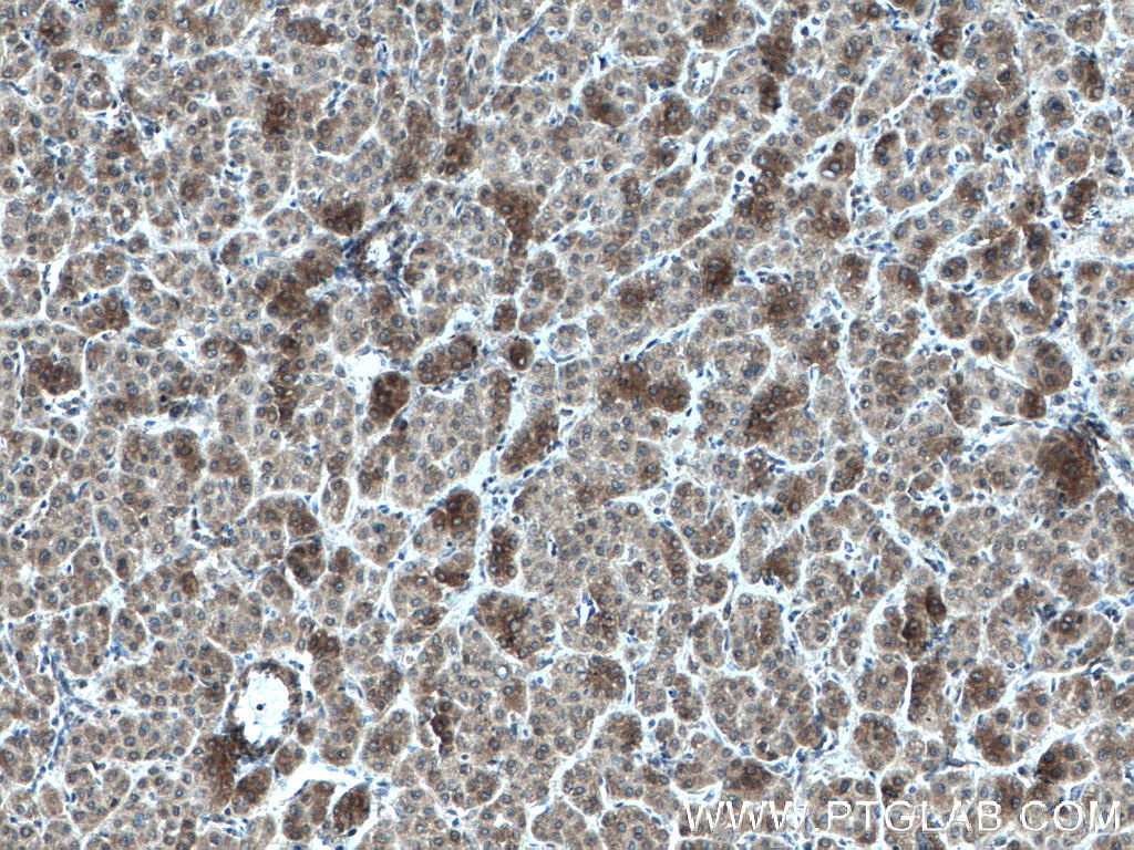 IHC staining of human liver cancer using 66677-1-Ig