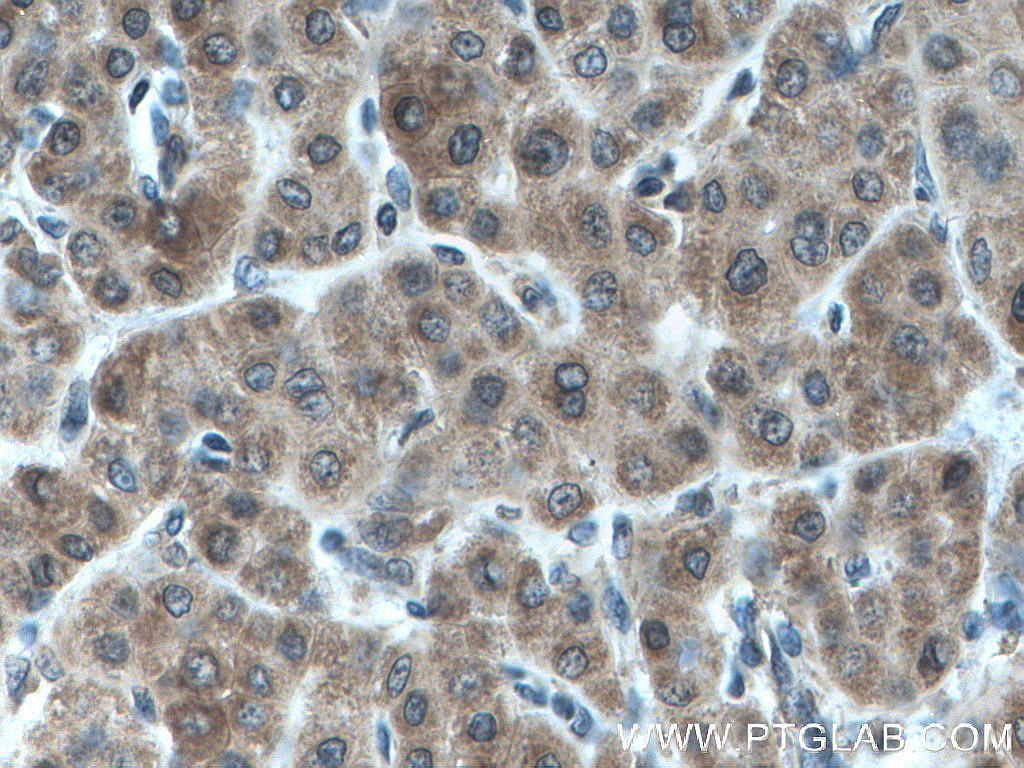IHC staining of human liver cancer using 66677-1-Ig (same clone as 66677-1-PBS)