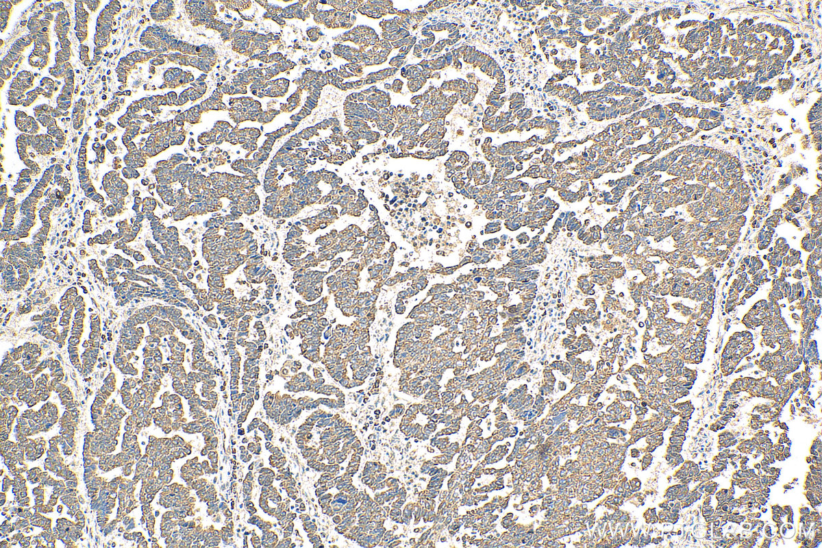 IHC staining of human ovary tumor using 10176-2-AP