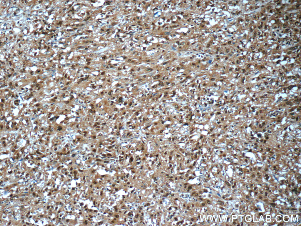 IHC staining of human cervical cancer using 60203-1-Ig