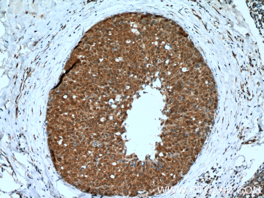 IHC staining of human breast cancer using 60203-1-Ig