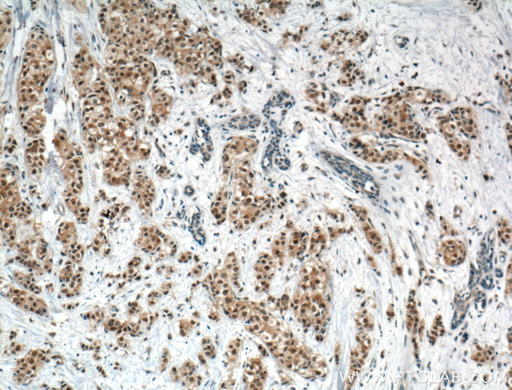 IHC staining of human breast cancer using 60203-2-Ig (same clone as 60203-2-PBS)