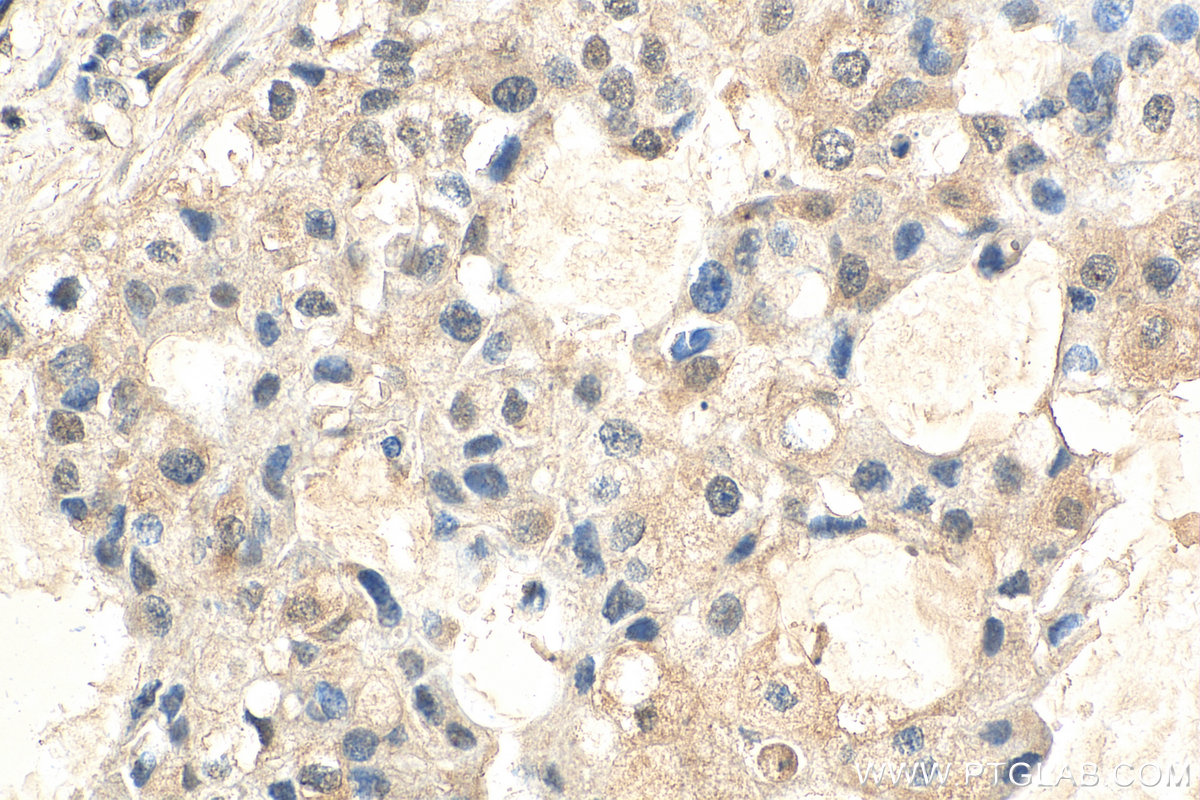 IHC staining of human breast cancer using 80457-1-RR
