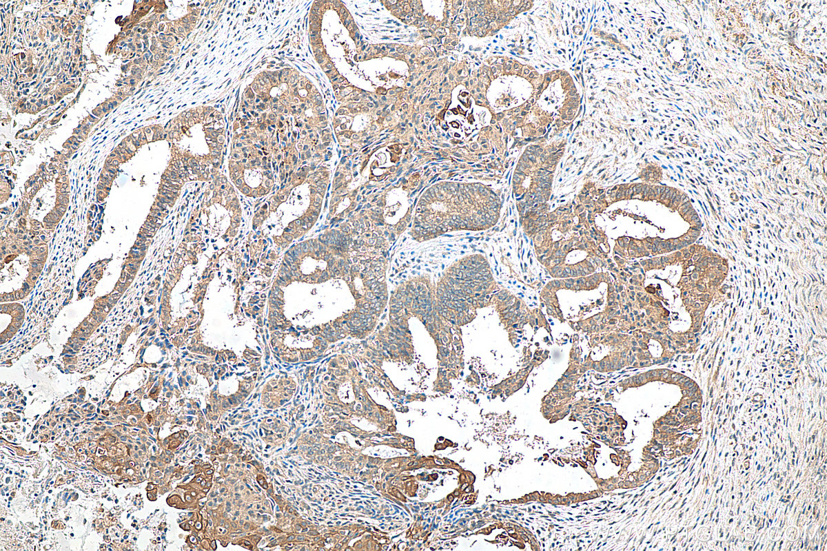 IHC staining of human ovary tumor using 80816-1-RR