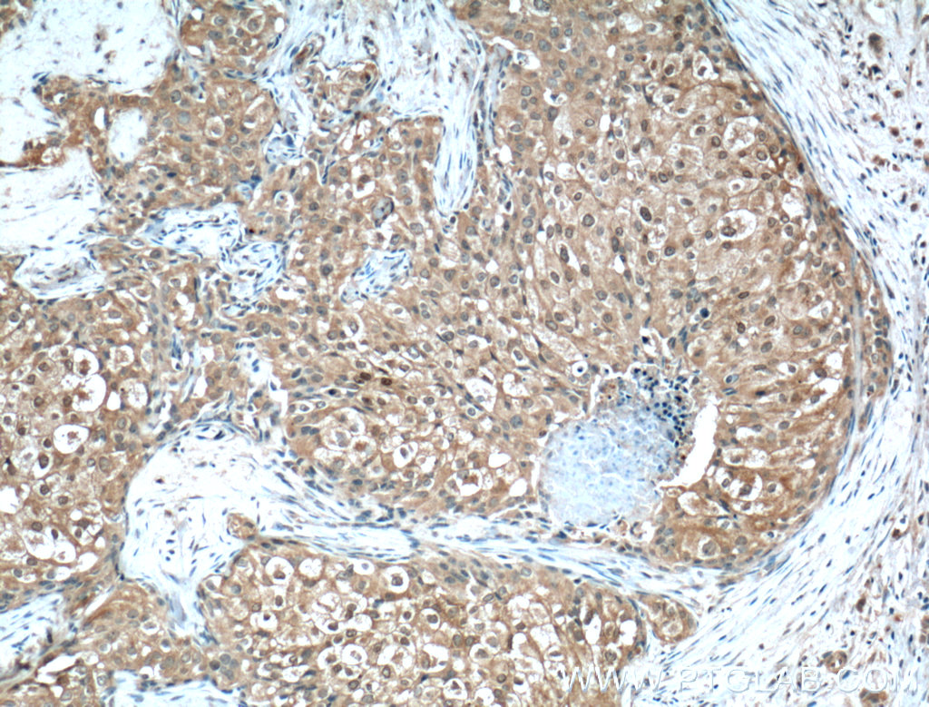 IHC staining of human breast cancer using 66444-1-Ig (same clone as 66444-1-PBS)