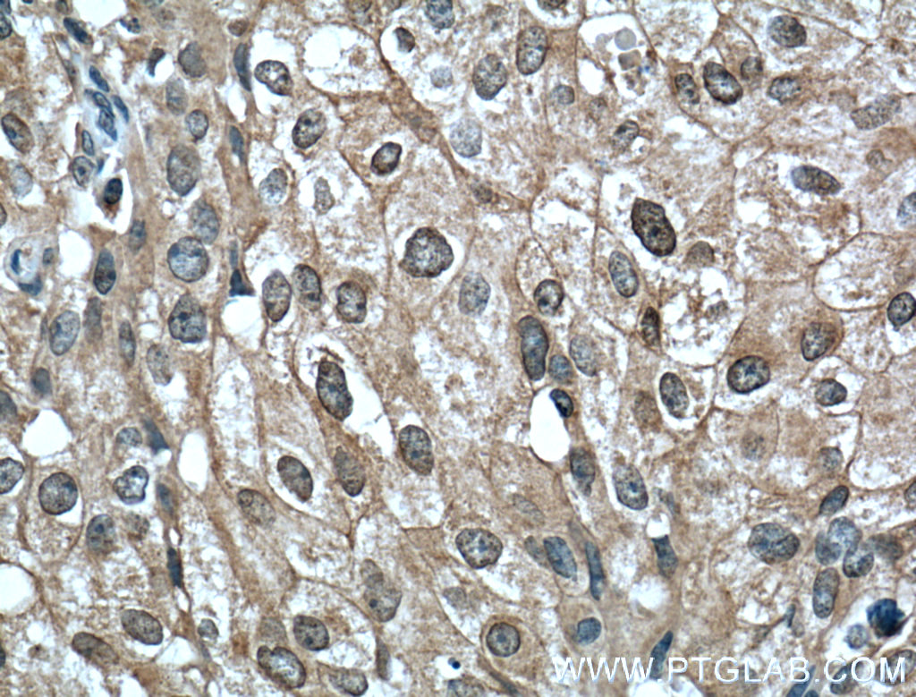 IHC staining of human breast cancer using 66444-1-Ig (same clone as 66444-1-PBS)