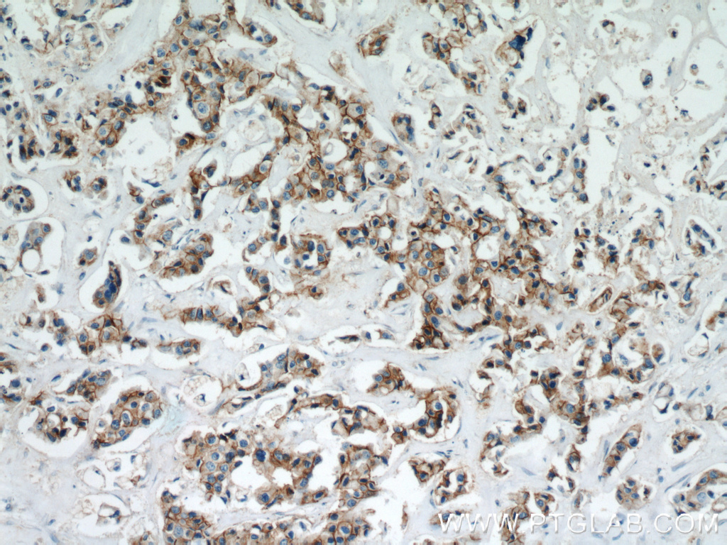 IHC staining of human breast cancer using 21972-1-AP