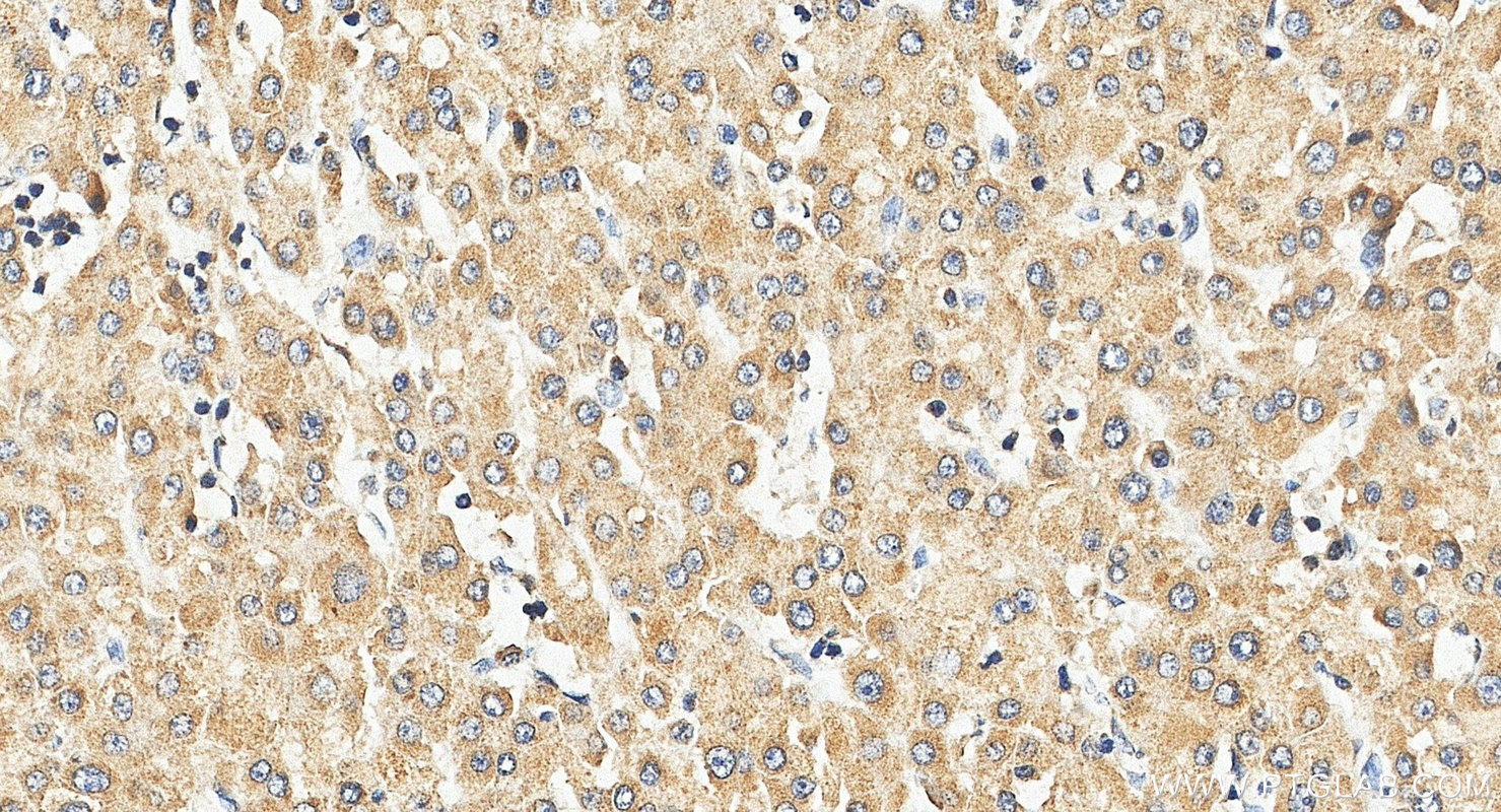 IHC staining of human liver cancer using 17719-1-AP IHC staining of human liver cancer using 17719-1-AP
