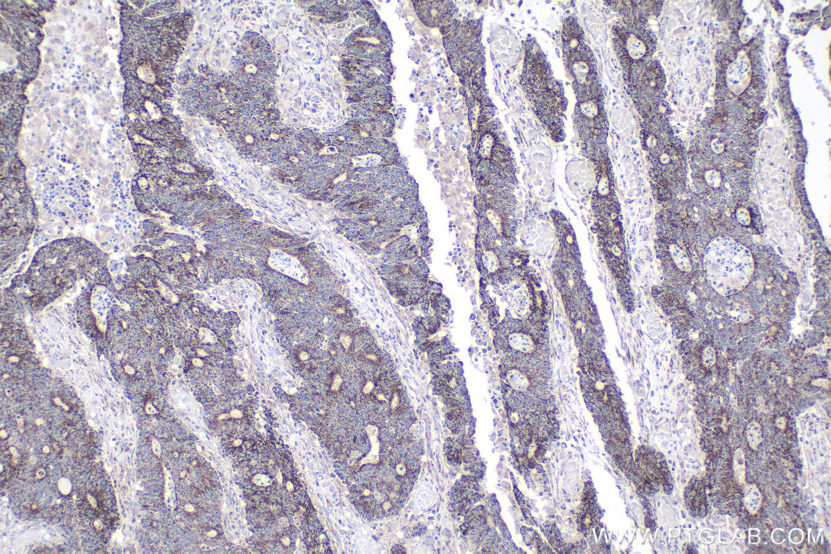 IHC staining of human colon cancer using 22220-1-AP