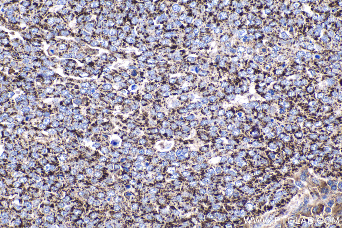 IHC staining of human ovary tumor using 22220-1-AP